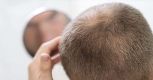 How Can I Fix My Failed Hair Transplant?