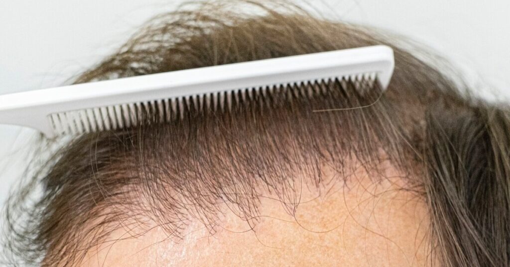 How To know of my hair transplant is successful?