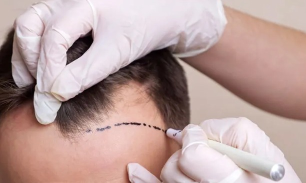 How Does Hair Transplant Help For Hair Growth?