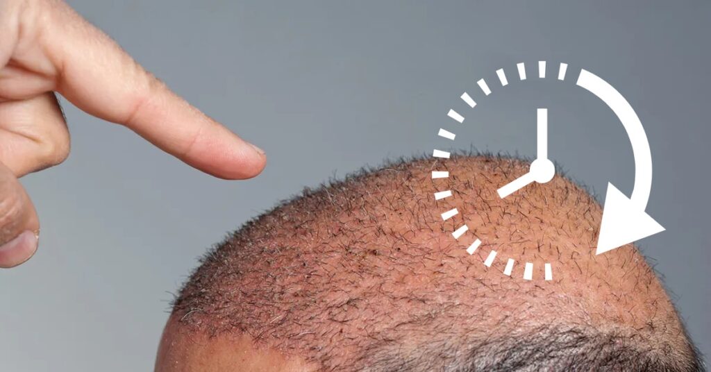 How-Long-do-to-wait-for-a-Revision-Hair-transplant