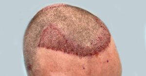 Are There Any Side Effects of Hair Transplant?