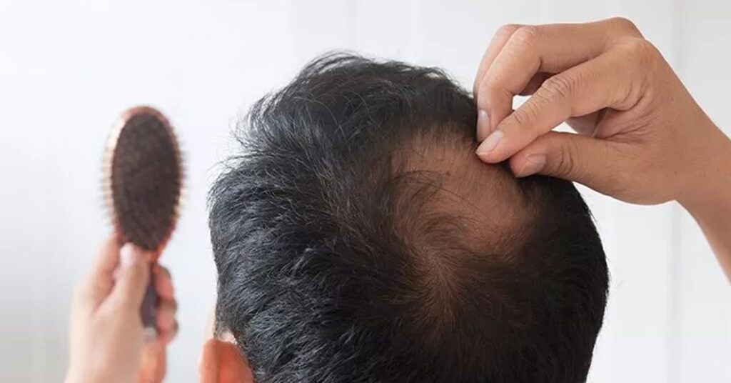 Techniques are available for Hair Transplants