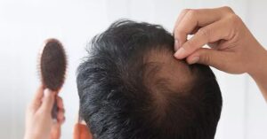 How many Techniques are available for Hair Transplants?