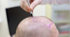 5 Advantages of Hair Transplant