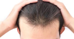 Important Things to Know Before Undergoing Hair Restoration