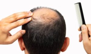 Is Hair Transplant Permanent?