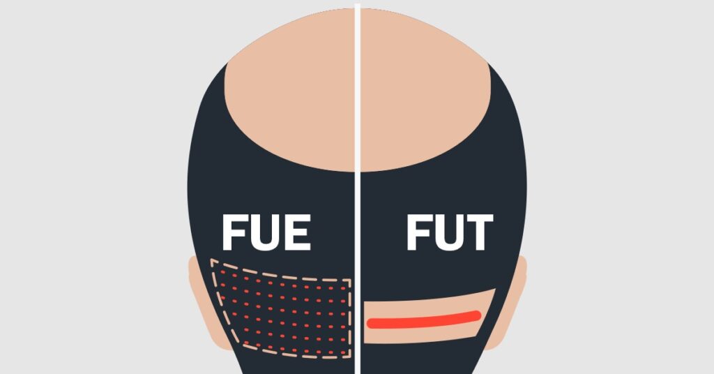 technique of hair transplant is better FUE or FUT