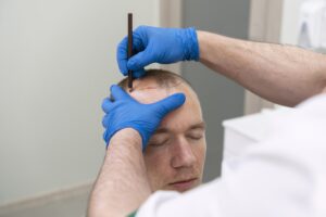 Is Hair Transplant Safe and Permanent?