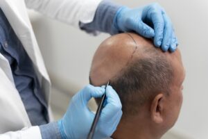 Surgical Vs Non Surgical Hair Restoration Methods