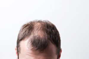 What is The Best Age for a Hair Transplant?